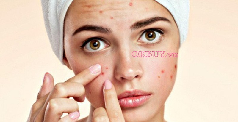 Nặn mụn có thể gây nhiều dầu, nhờn trên da mặt