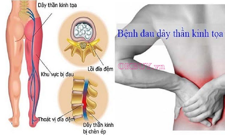 Đau thần kinh tọa có thể gây đau nhức vùng mông xuống chân