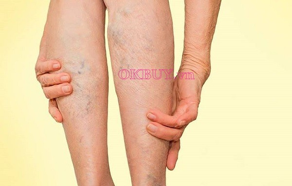Suy tĩnh mạch có thể là căn bệnh do tê hay tê bị tê tay chân và chuột rút gây ra