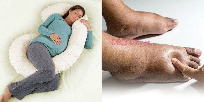 Phù chân khi mang thai do rối loạn nội tiết tố 
