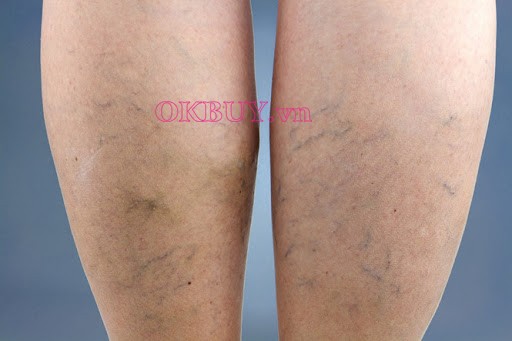 Suy giãn tĩnh mạch gây đau nhức bắp chân về đêm