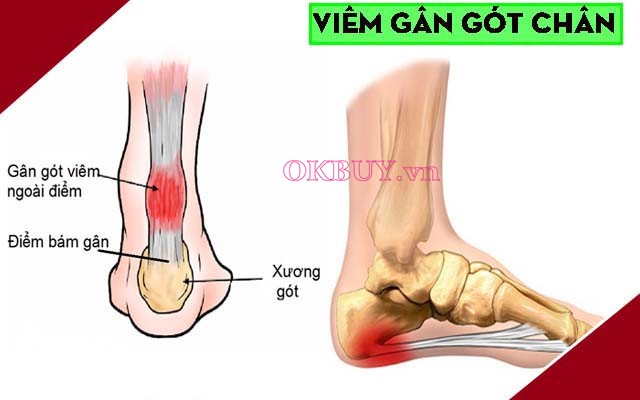 Viêm gân gót chân gây đau xương gót chân