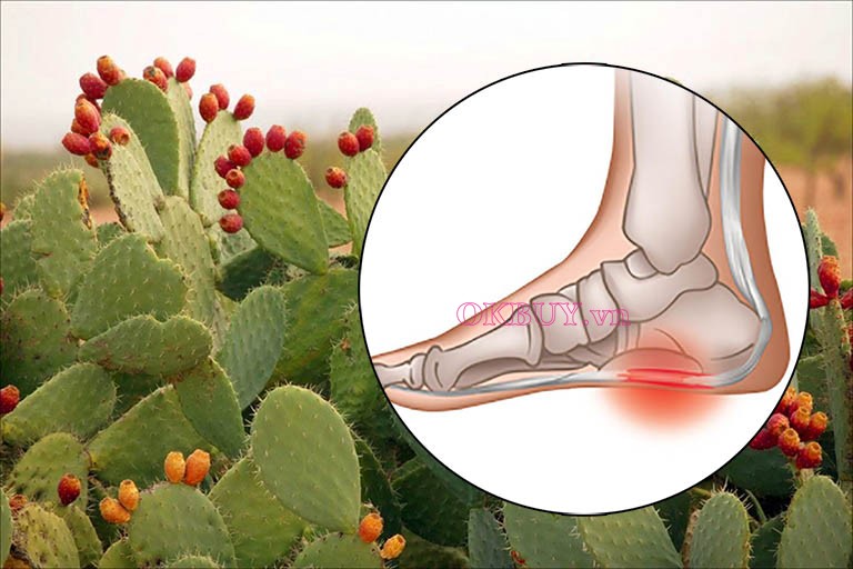 Xương rồng trị gai gót chân có hiệu quả không
