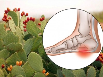 Giải đáp thắc mắc: xương rồng trị gai gót chân có thật sự hiệu quả không?
