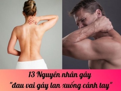 13 Nguyên nhân gây đau vai gáy lan xuống cánh tay